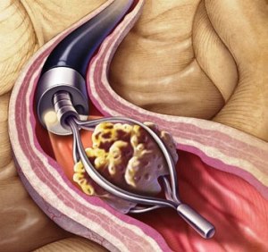 phototake_rm_photo_of_ureteroscopy